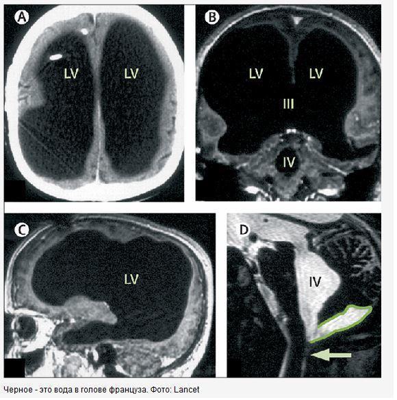 Француз 50 лет живет без мозга